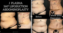 Dr. Yavuz Ozsular's Private Practice - Before/After 1