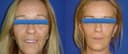 Dr. Çağrı Sade Plastic Surgery Center - Before/After 2