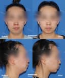 Shinsang Plastic Surgery Clinic - Before/After 4