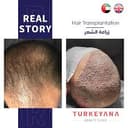 Turkeyana Clinic - Before/After 3