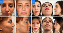 Istanbul Aesthetic Plastic Surgery Center - Before/After 1
