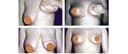 Dr. Çağrı Sade Plastic Surgery Center - Before/After 1