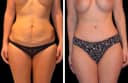 Istanbul Aesthetic Plastic Surgery Center - Before/After 3