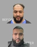 Turkeyana Clinic - Before/After 2