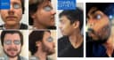 Istanbul Aesthetic Plastic Surgery Center - Before/After 2