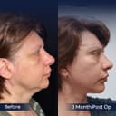 Istanbul Aesthetic Plastic Surgery Center - Before/After 4