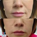 Epimis Estetic Clinic - Before/After 4