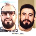 Hair Clinic, Istanbul - Before/After 2