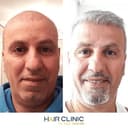 Hair Clinic, Istanbul - Before/After 3