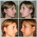 Bangkok Plastic Surgery - Before/After 4