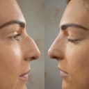 The Nose Aesthetic Clinic - Before/After 2