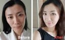 Banobagi Plastic Surgery - Before/After 4