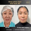 ID Clinic Bangkok - Before/After 1