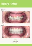 Evergreen Dental - Before/After 3