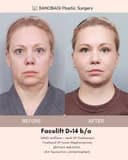 Banobagi Plastic Surgery - Before/After 3