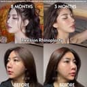 Bangkok Plastic Surgery - Before/After 3