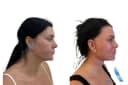 Bangkok Plastic Surgery - Before/After 2