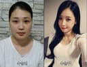 Banobagi Plastic Surgery - Before/After 1