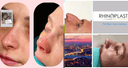 The Nose Aesthetic Clinic - Before/After 3