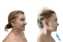 Bangkok Plastic Surgery - Before/After 1