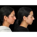 The Nose Aesthetic Clinic - Before/After 1