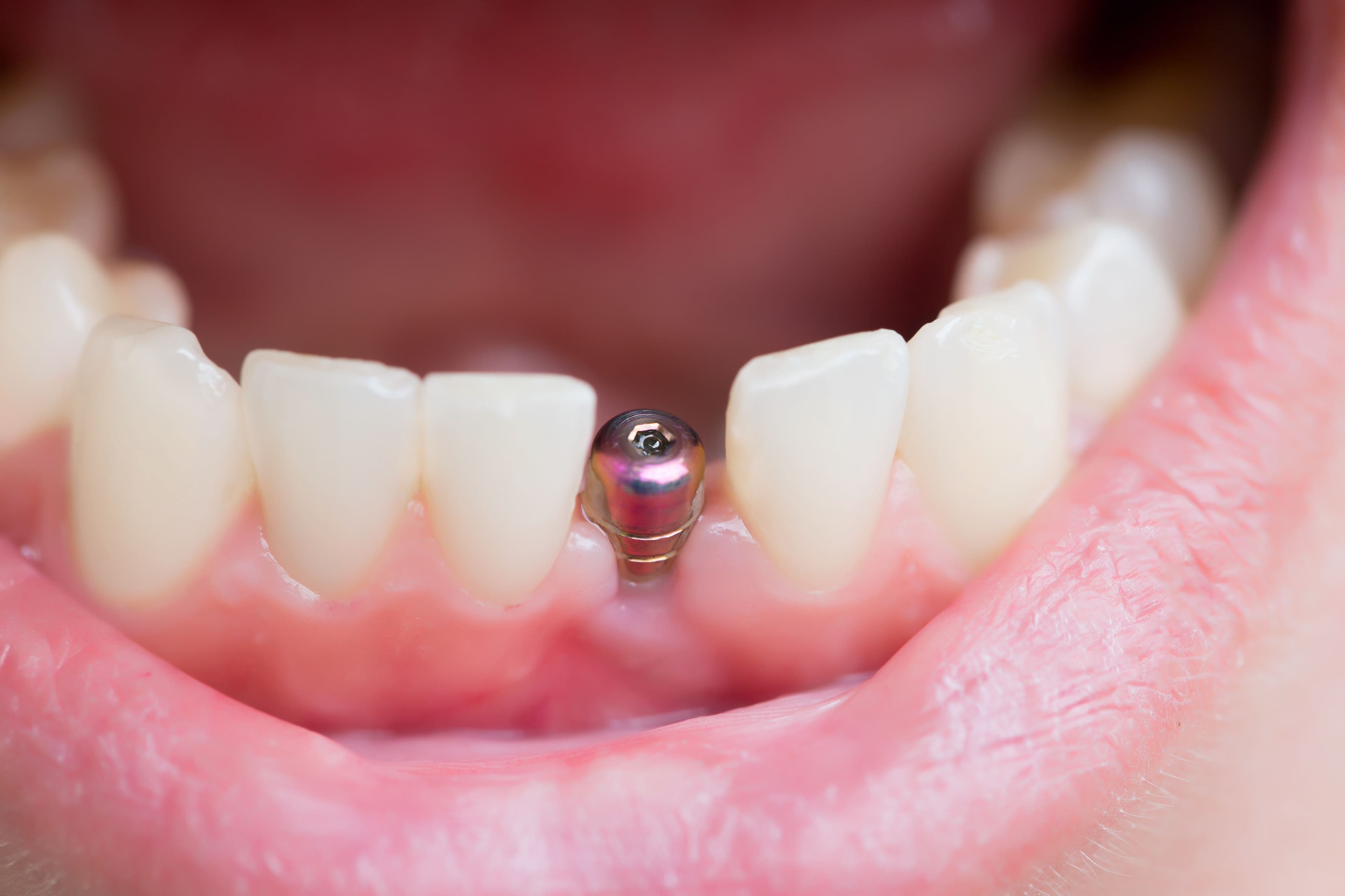 10 Best and Cheapest Countries for Dental Implants Abroad