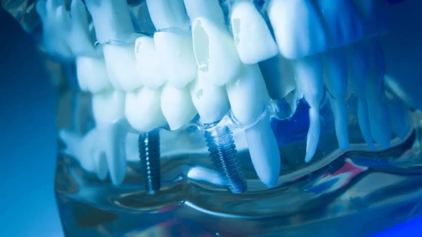 All-on-6 Dental Implants Poland