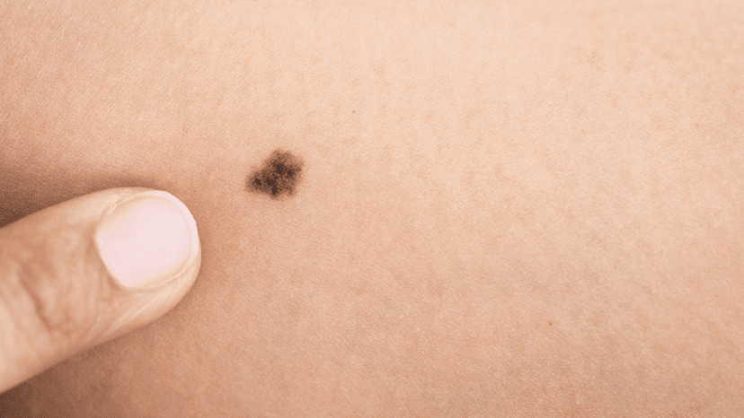 Melanoma (Skin Cancer) Treatment in Turkey - Best Clinics