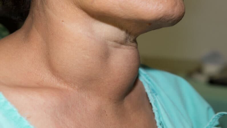 Thyroid Disease Treatment in Turkey - Best Clinics and Costs