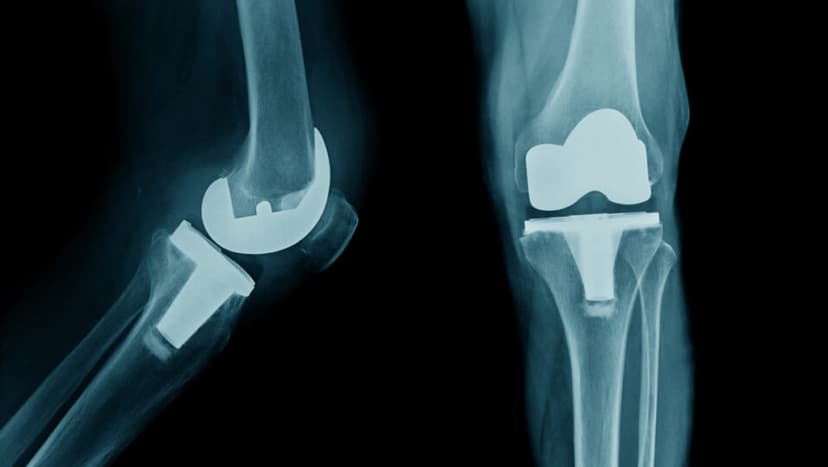 Best Countries for Knee Replacement Surgery Abroad