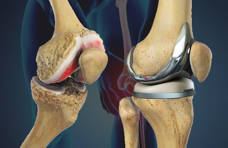 Best Clinics for Total Knee Replacement Surgery Abroad