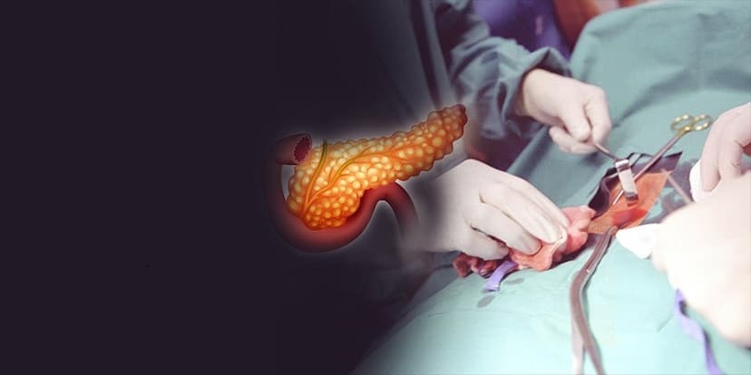 Pancreas Surgery in Turkey - Clinics, Doctors & Reviews