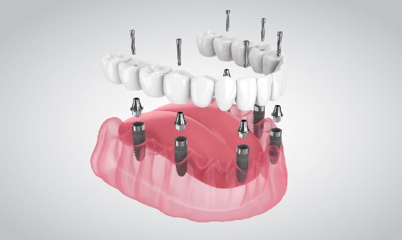 7 Best and Cheapest Countries for All-on-6 Dental Implants Abroad