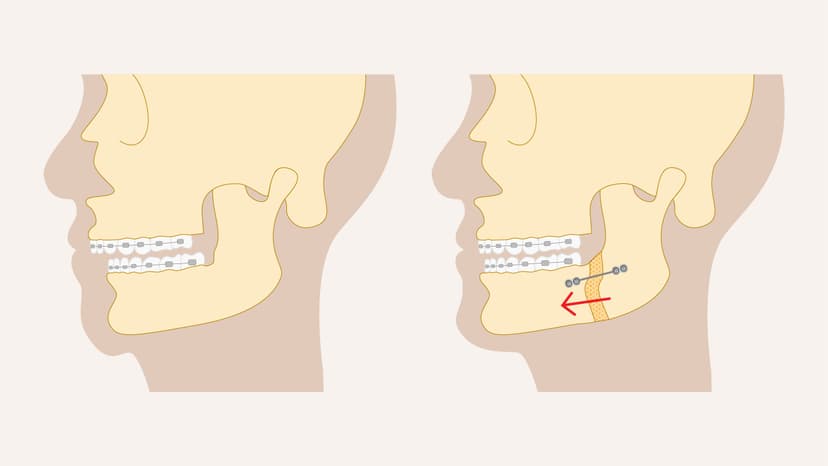 Orthognathic Surgery (Jaw Surgery) in Turkey