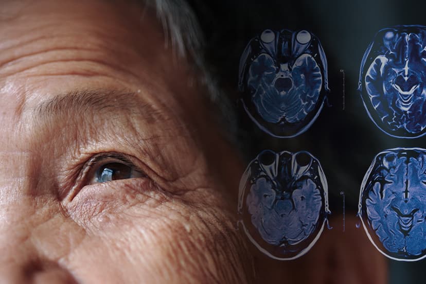 DBS, FUS, or Rehab? Choosing the Right Parkinson’s Treatment