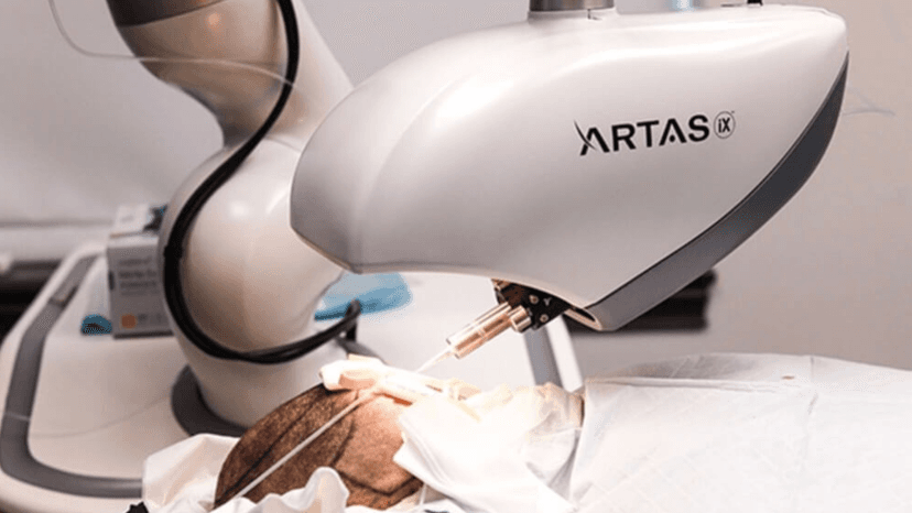 Robotic Hair Transplant in Istanbul, Turkey