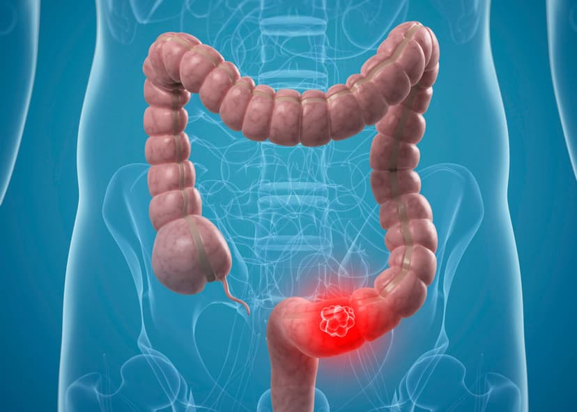 Colon Cancer Treatment in Turkey - Best Clinics & Doctors