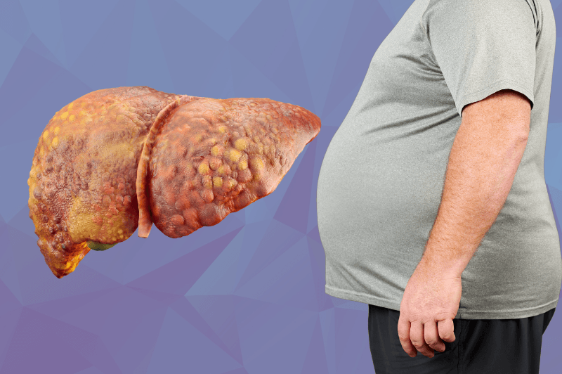 Fatty Liver Disease Treatment in Turkey - Costs & Clinics