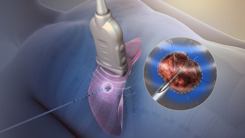Radiofrequency Ablation in Turkey (Chronic Pain Treatment)