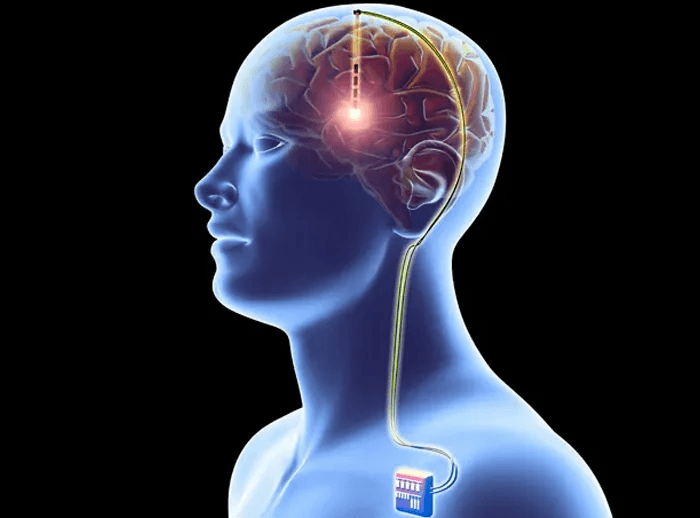 Deep Brain Stimulation (DBS) Surgery in Turkey - Cost & Doctors