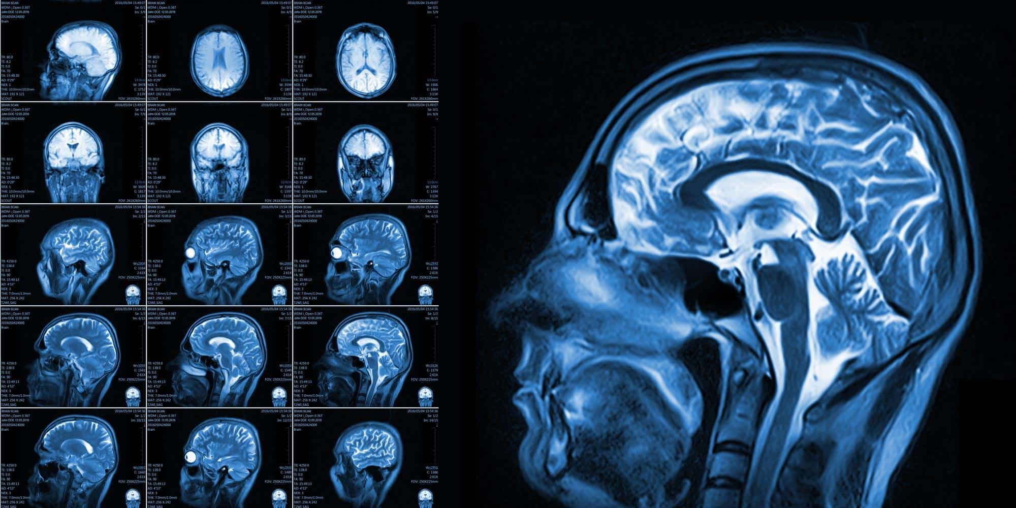 Deep Brain Stimulation in Turkey: A Complete Guide for 2026