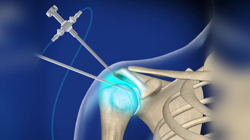 Arthroscopic Shoulder Surgery Abroad
