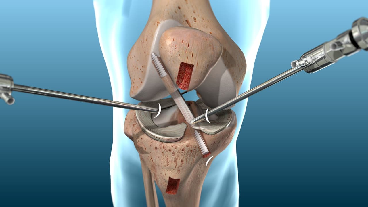 ACL Reconstruction Surgery Abroad