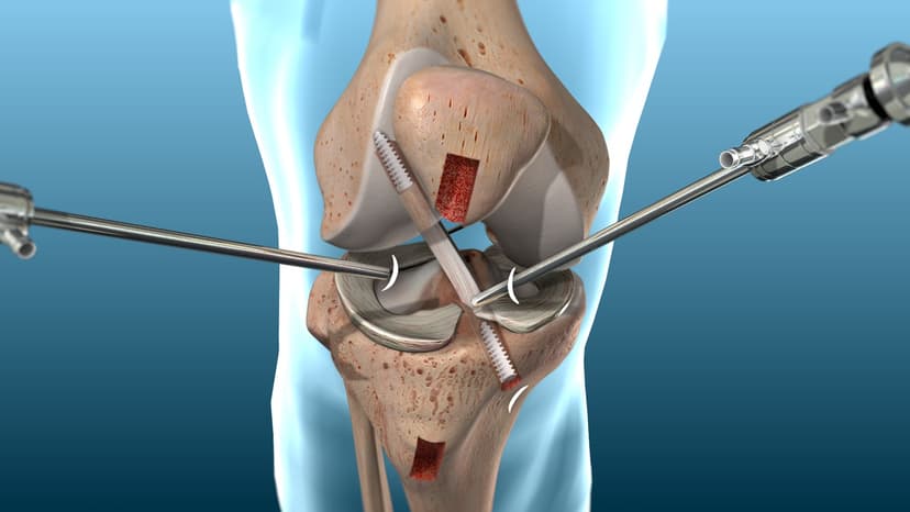 ACL Reconstruction Surgery Abroad