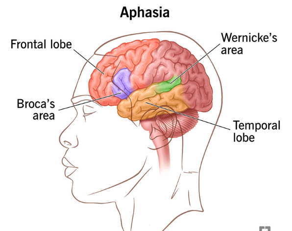 Aphasia medical condition