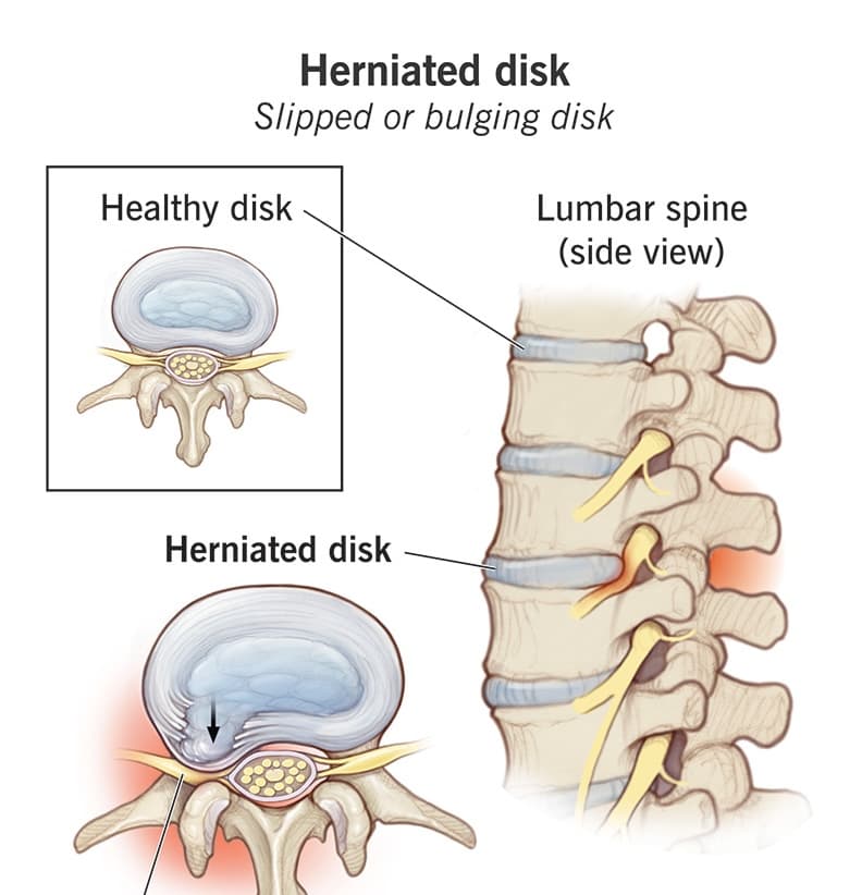 Lumbar herniated disc medical condition