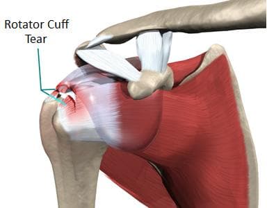 Shoulder Rotator Cuff Tears medical condition