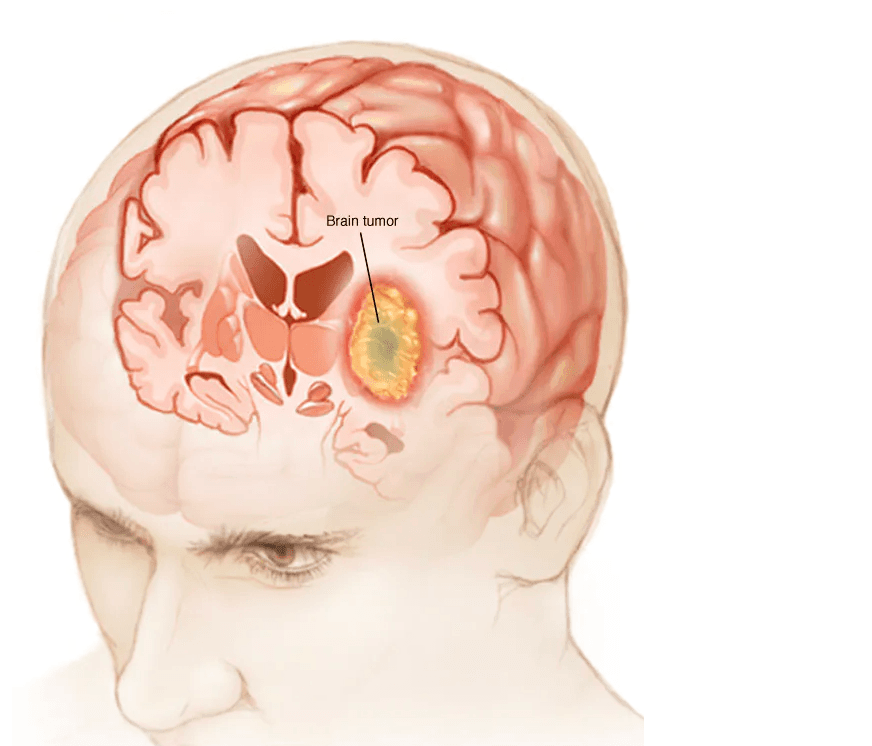 Brain Tumors medical condition