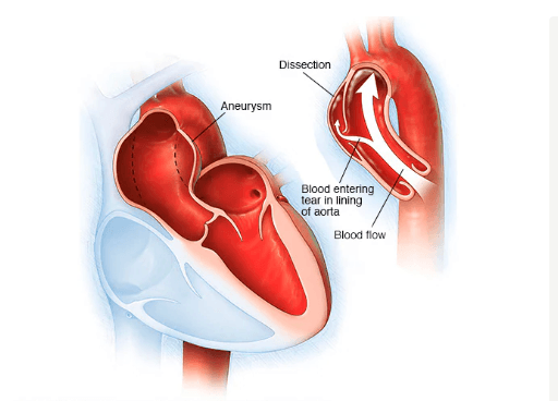Aortic Aneurysm and Dissection medical condition