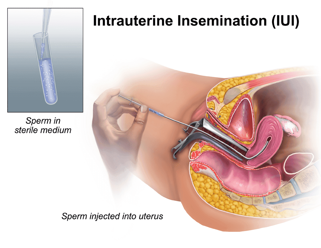 Artificial insemination medical condition